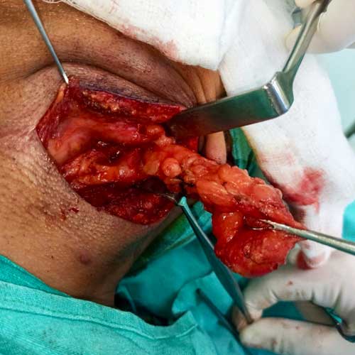 Massive Lipoma removal from Neck