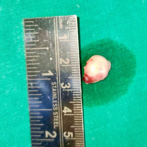 Peripheral Granuloma removal with Laser