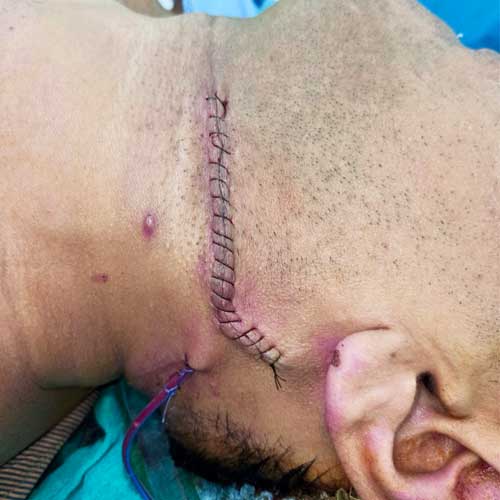 Massive Lipoma removal from Neck