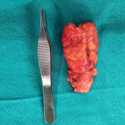 Massive Lipoma removal from Neck
