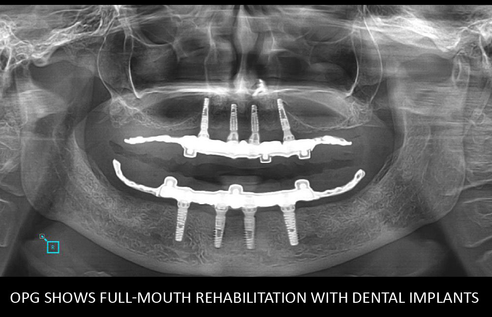 OPG shows full-mouth rehabilitation with dental implants
