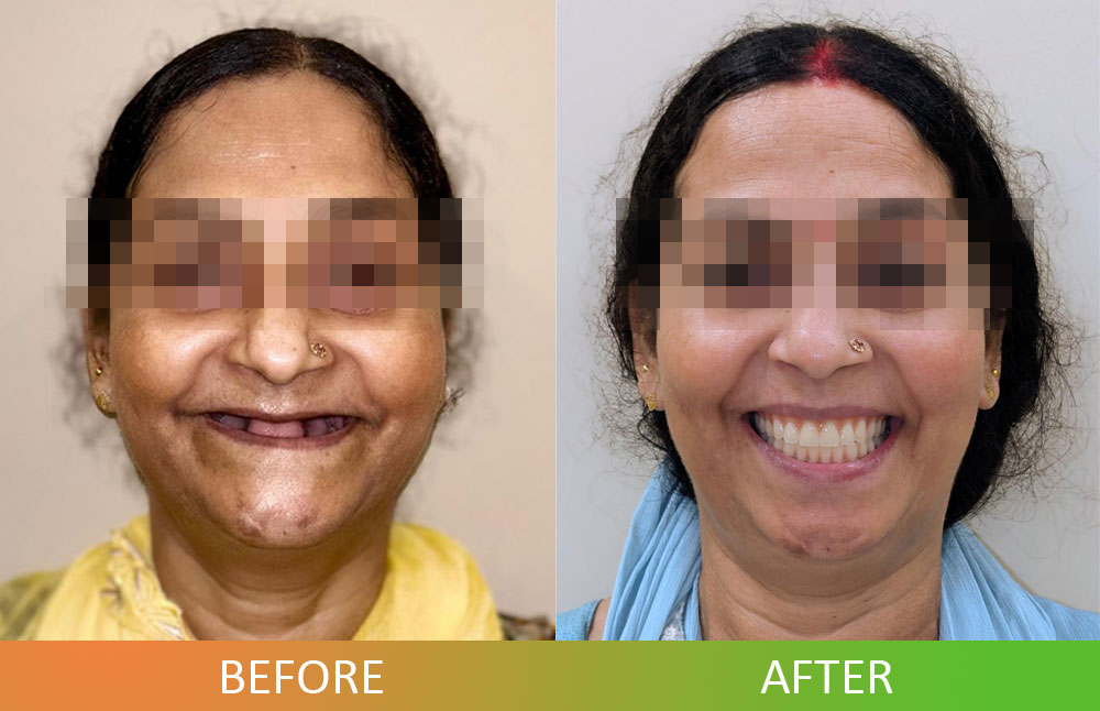 patient before and after photo of full-mouth rehabilitation with dental implants