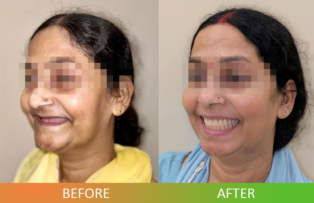 patient before and after photo of full-mouth rehabilitation with dental implants