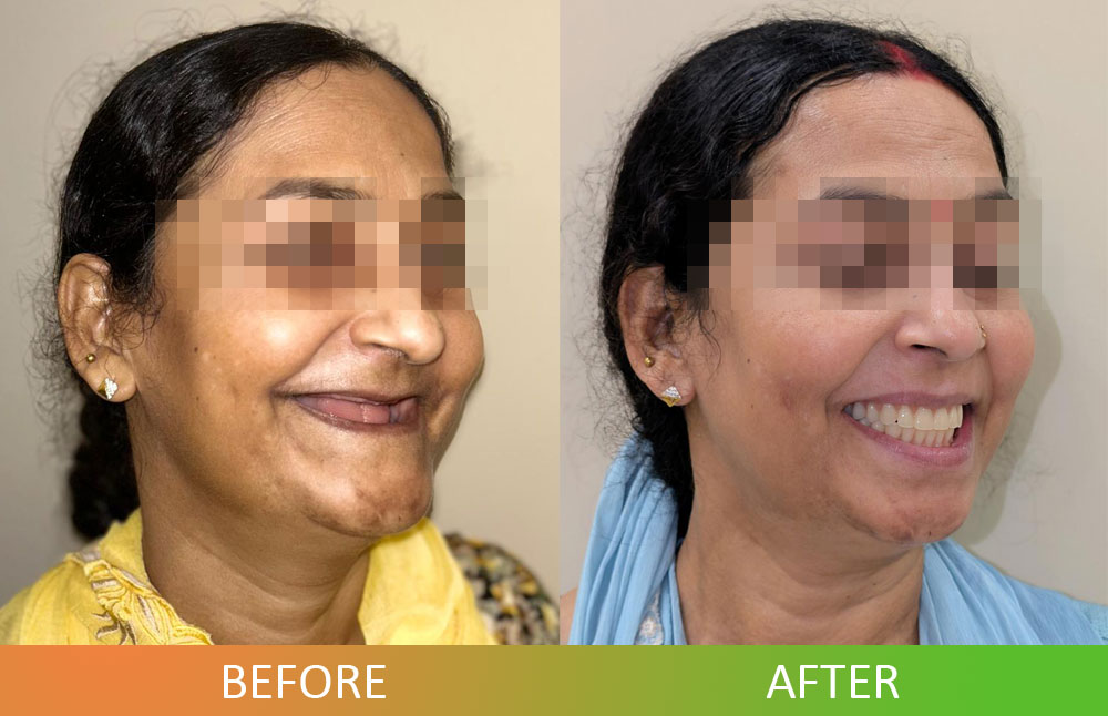 patient before and after photo of full-mouth rehabilitation with dental implants
