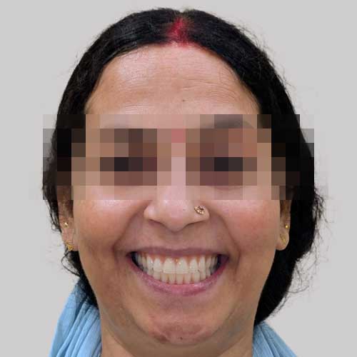 patient photo after full mouth implants