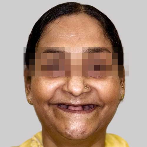 patient photo before full mouth implants