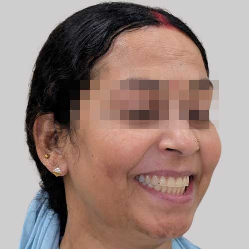 patient photo after full mouth implants