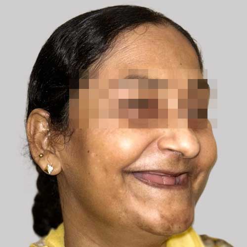 patient photo before full mouth implants