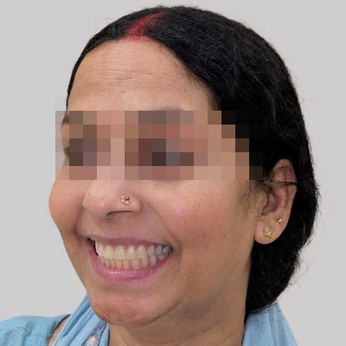 patient photo after full mouth implants