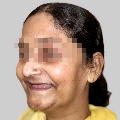 patient photo before full mouth implants