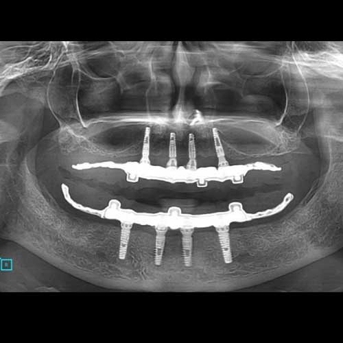 OPG shows full-mouth rehabilitation