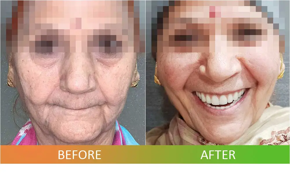 Dental Implants Full Mouth Rehabilitation All-On-4 Technique