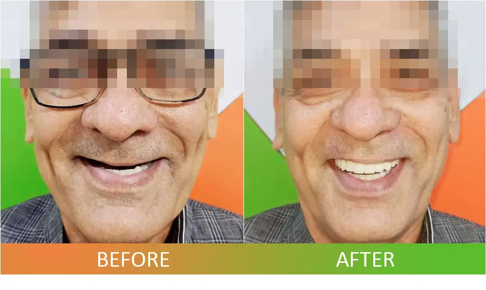 Full Arch Dental Implant Prosthesis All-on-6 Technique