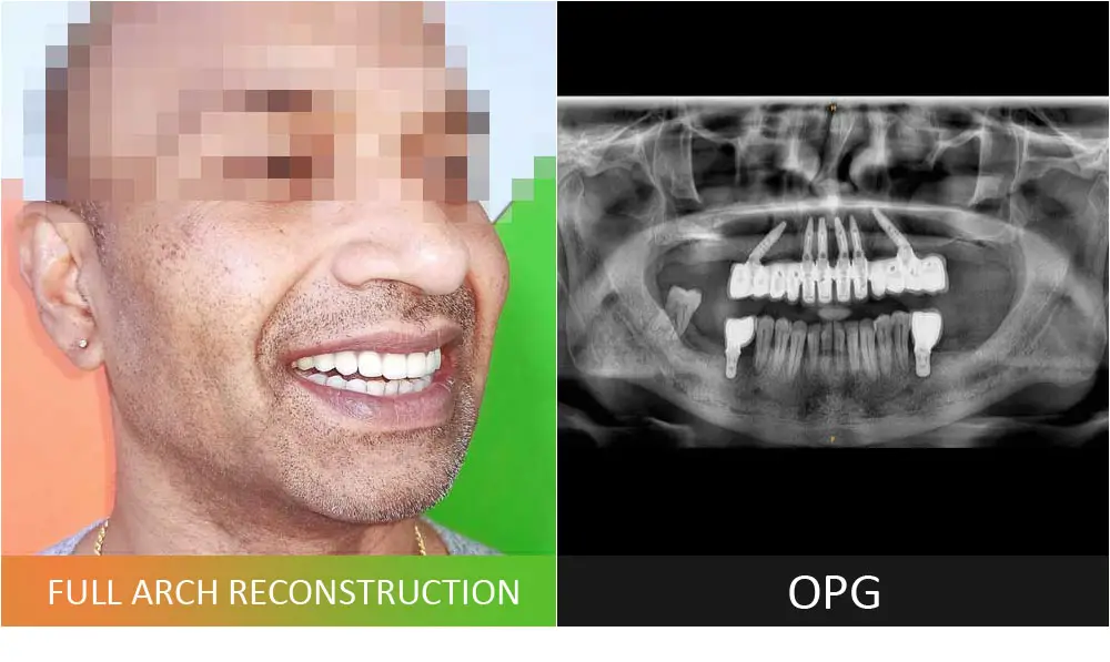 Full Arch Reconstruction with Dental Implants