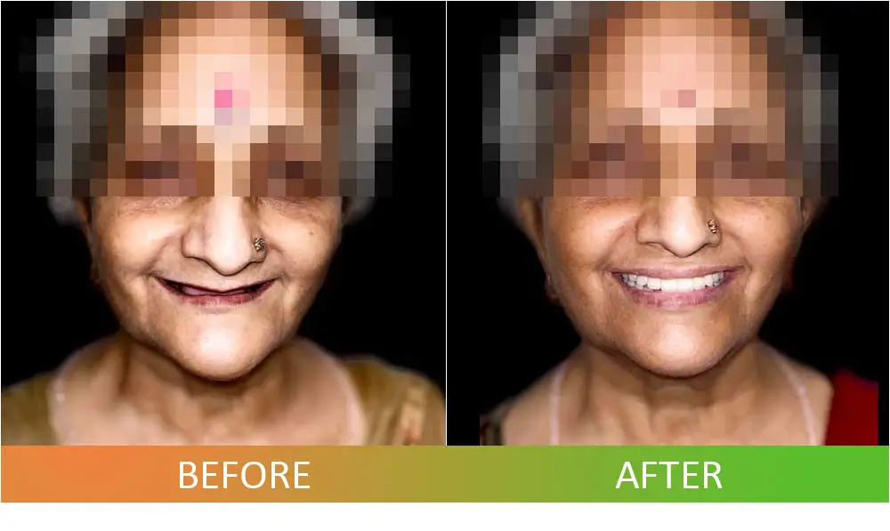 Full Mouth Rehabilitation All-on-6