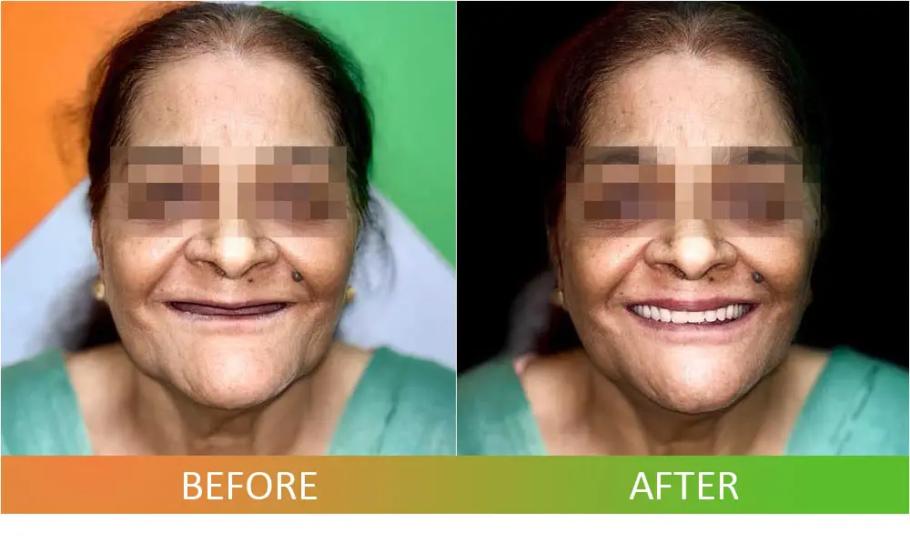 Implant Retained Prosthesis