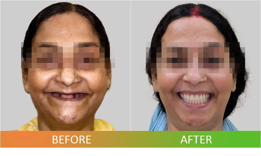 Full Mouth Dental Implants