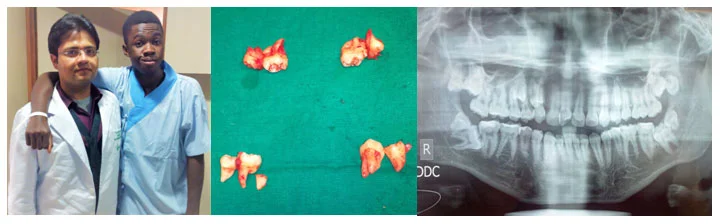 impacted tooth surgery by Oral and Maxillofacial Surgeon